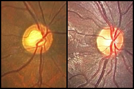 左）緑内障の眼底、右）正常の眼底